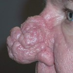 Rhinophyma